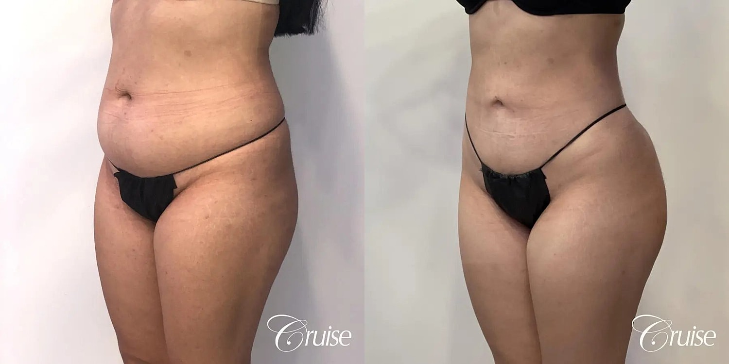 Liposuction Before & After