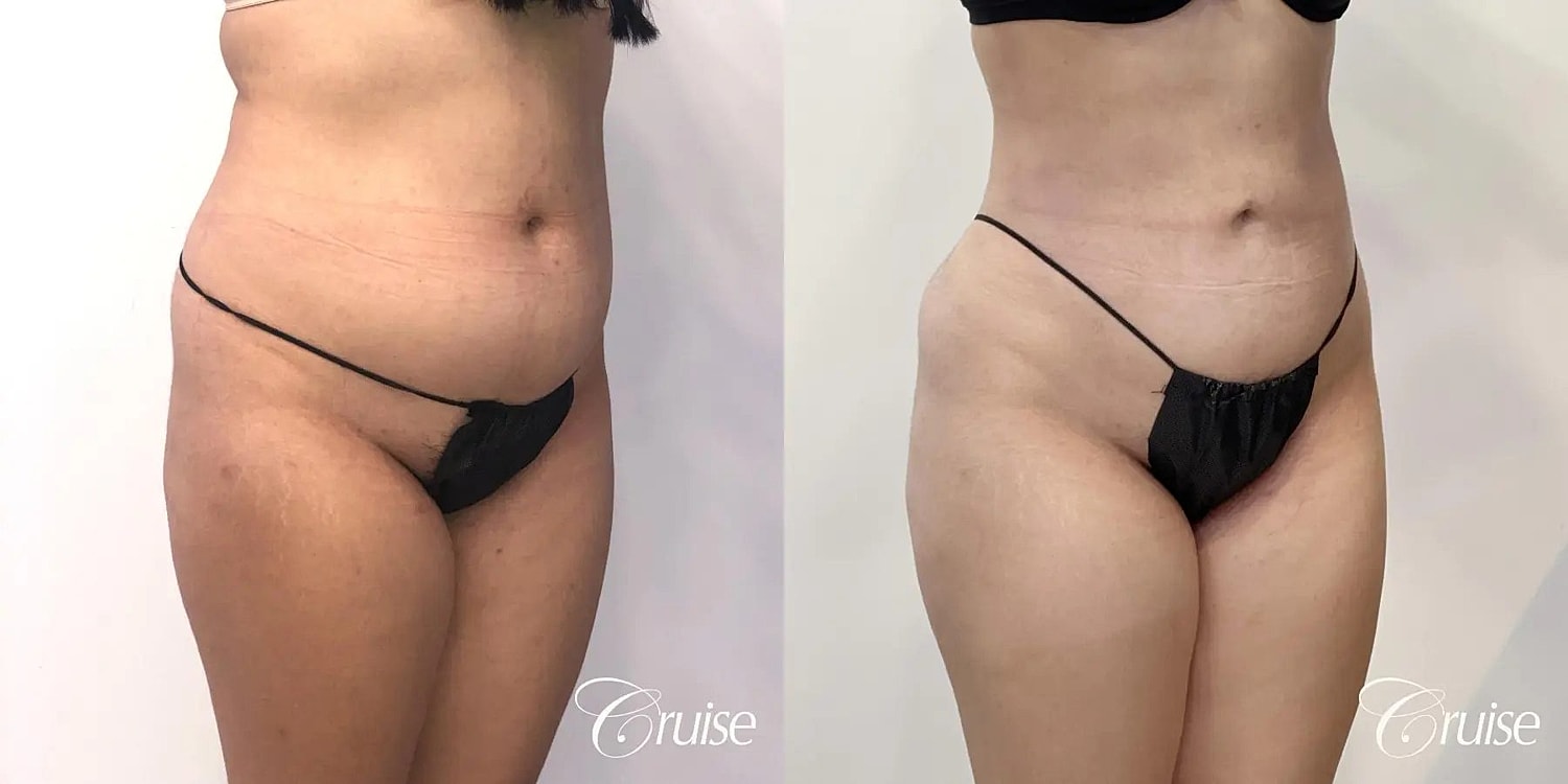 Liposuction Before & After