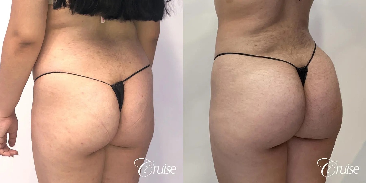 Liposuction Before & After
