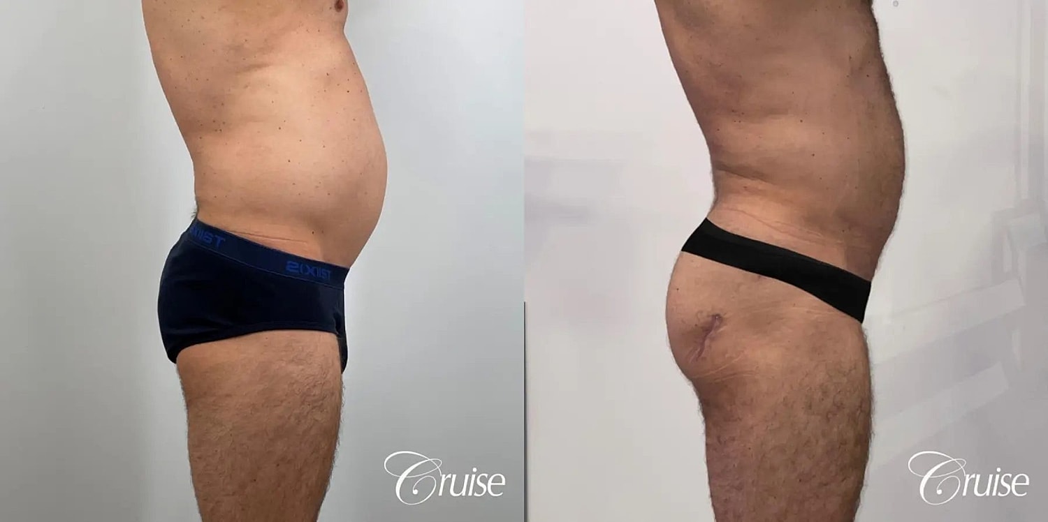 Liposuction Before & After