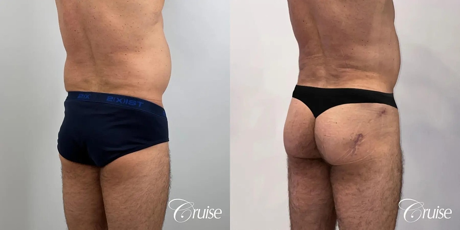 Liposuction Before & After