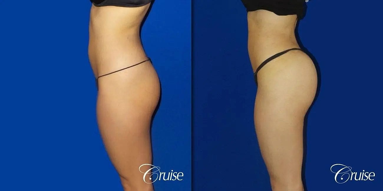 Liposuction Before & After