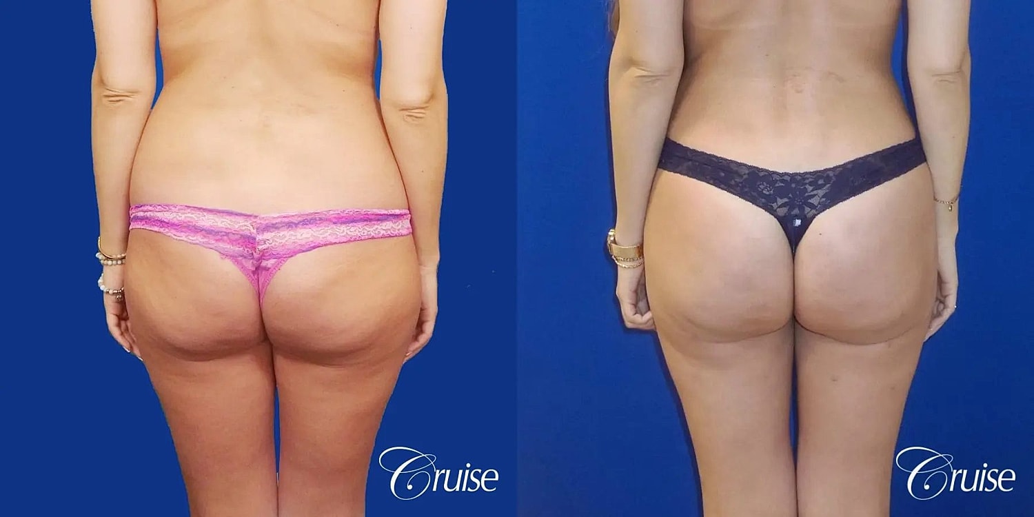 Liposuction Before & After