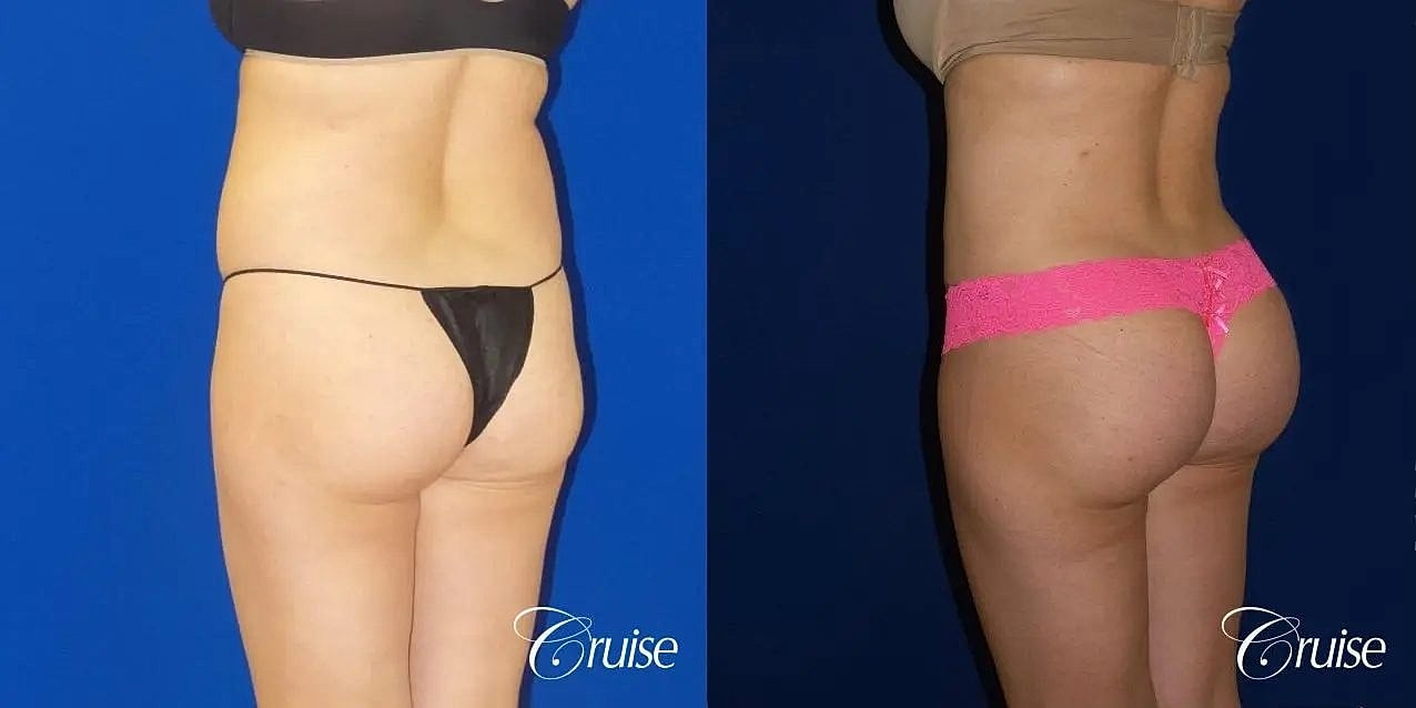 Liposuction Before & After