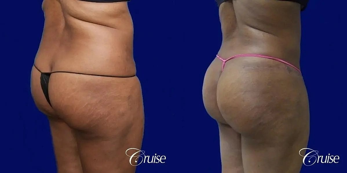 Liposuction Before & After