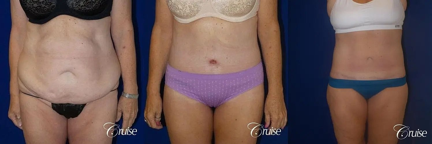 Liposuction Before & After