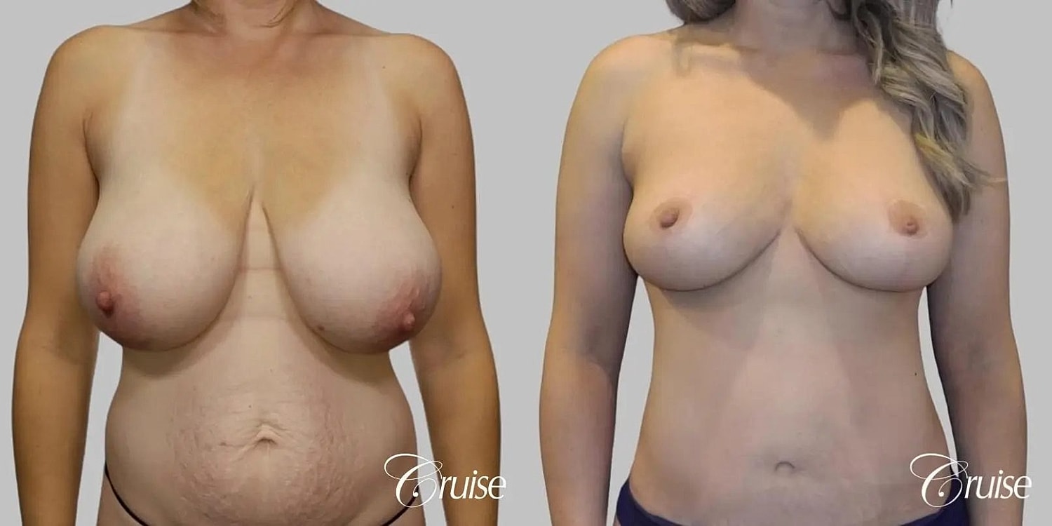 Breast Reduction Before & After