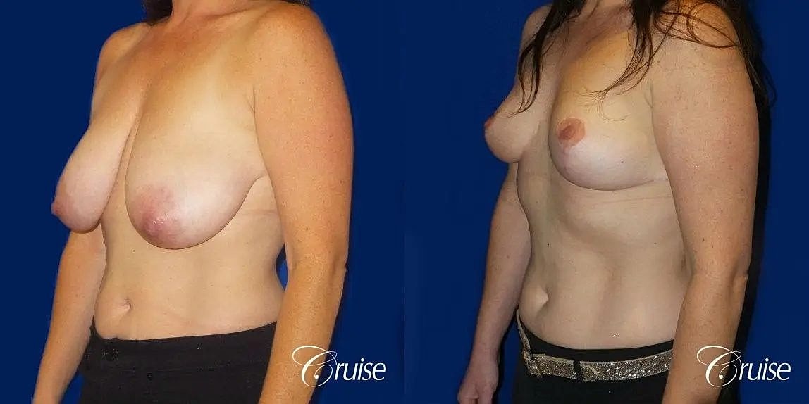 Breast Reduction Before & After