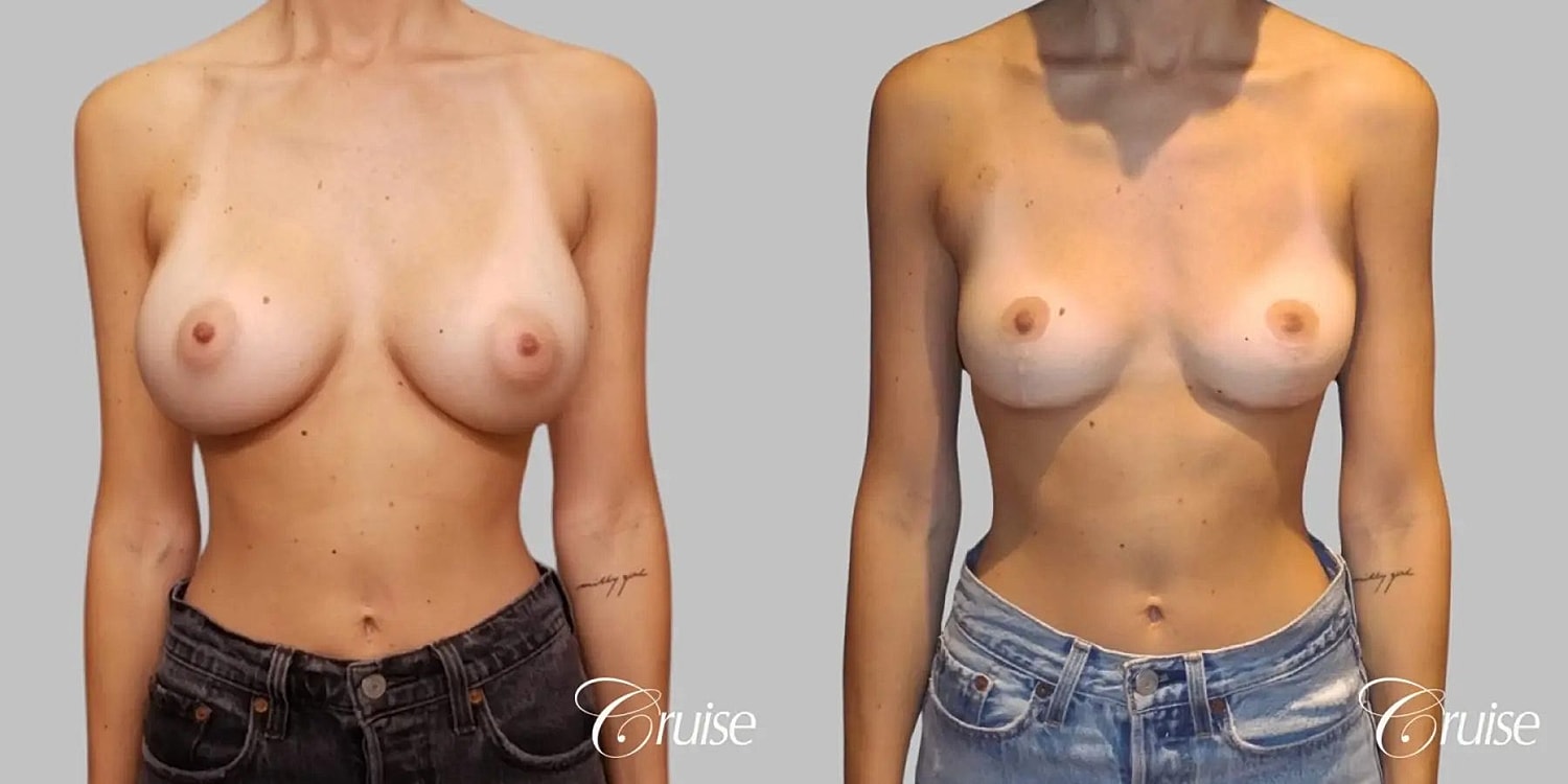 Breast Reduction Before & After