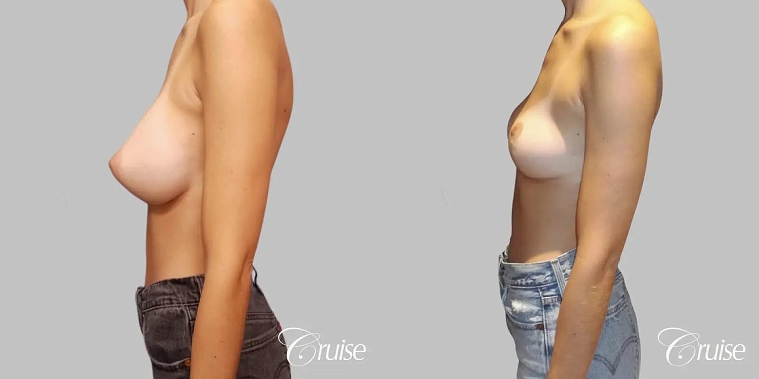 Breast Reduction Before & After