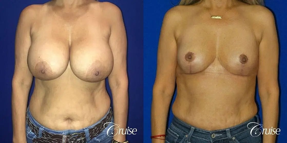 Breast Reduction Before & After