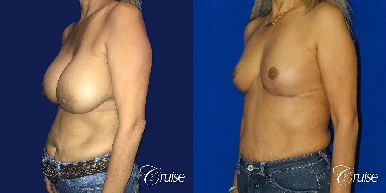 Breast Reduction Before & After