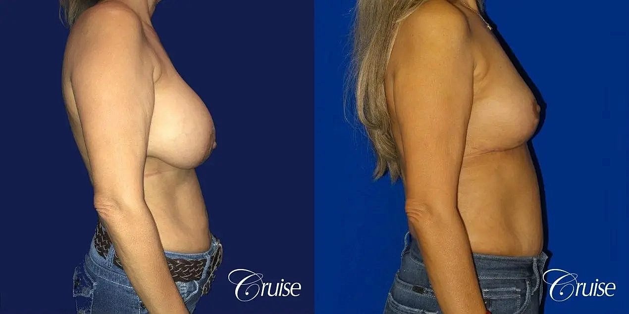 Breast Reduction Before & After