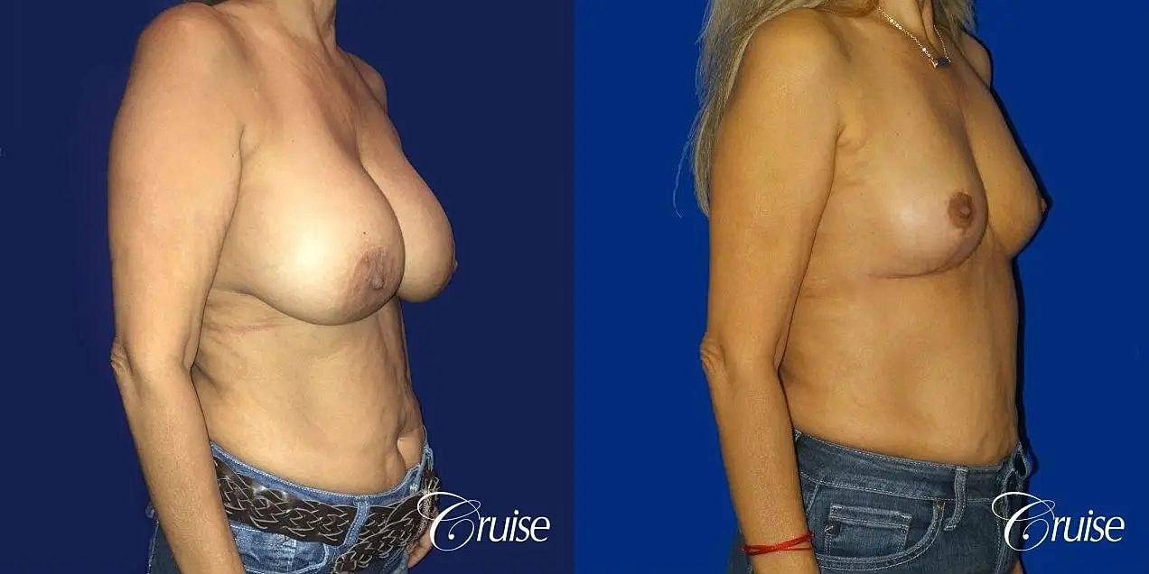 Breast Reduction Before & After