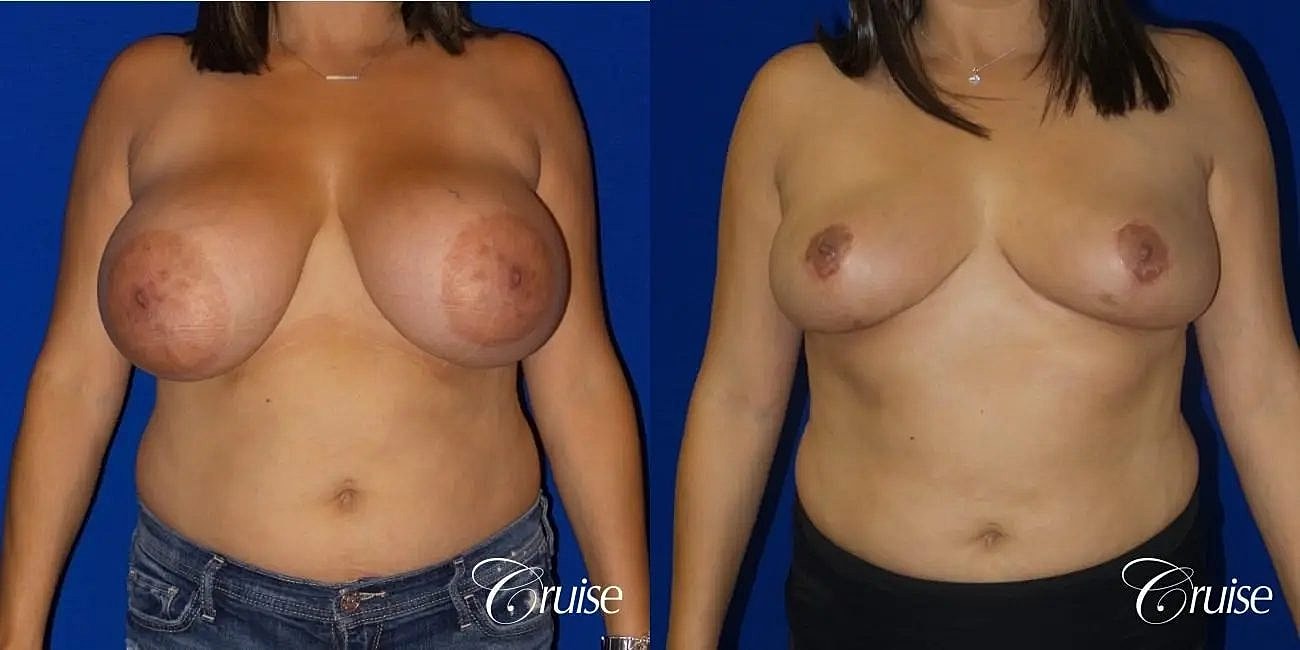 Breast Reduction Before & After