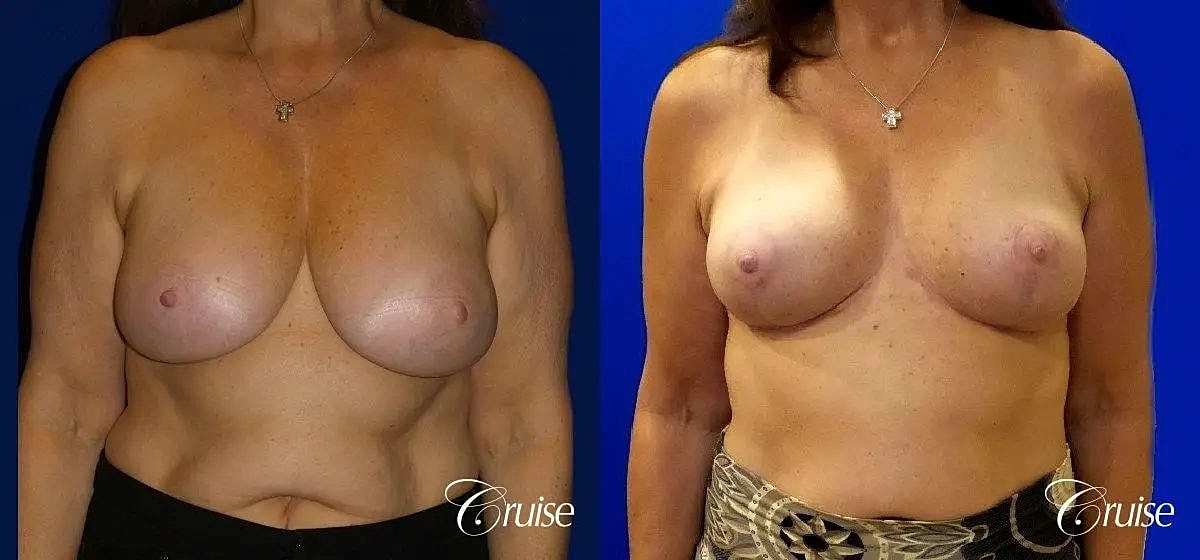 Breast Reduction Before & After