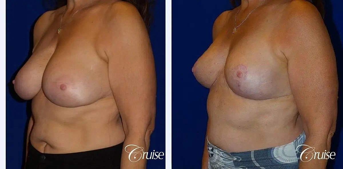 Breast Reduction Before & After