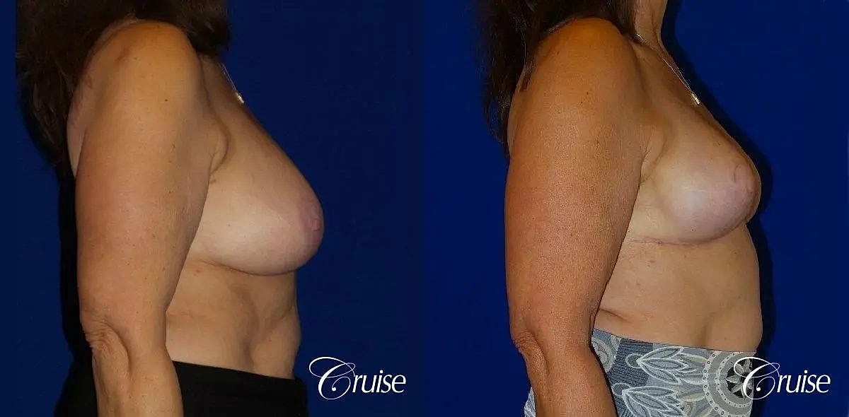 Breast Reduction Before & After