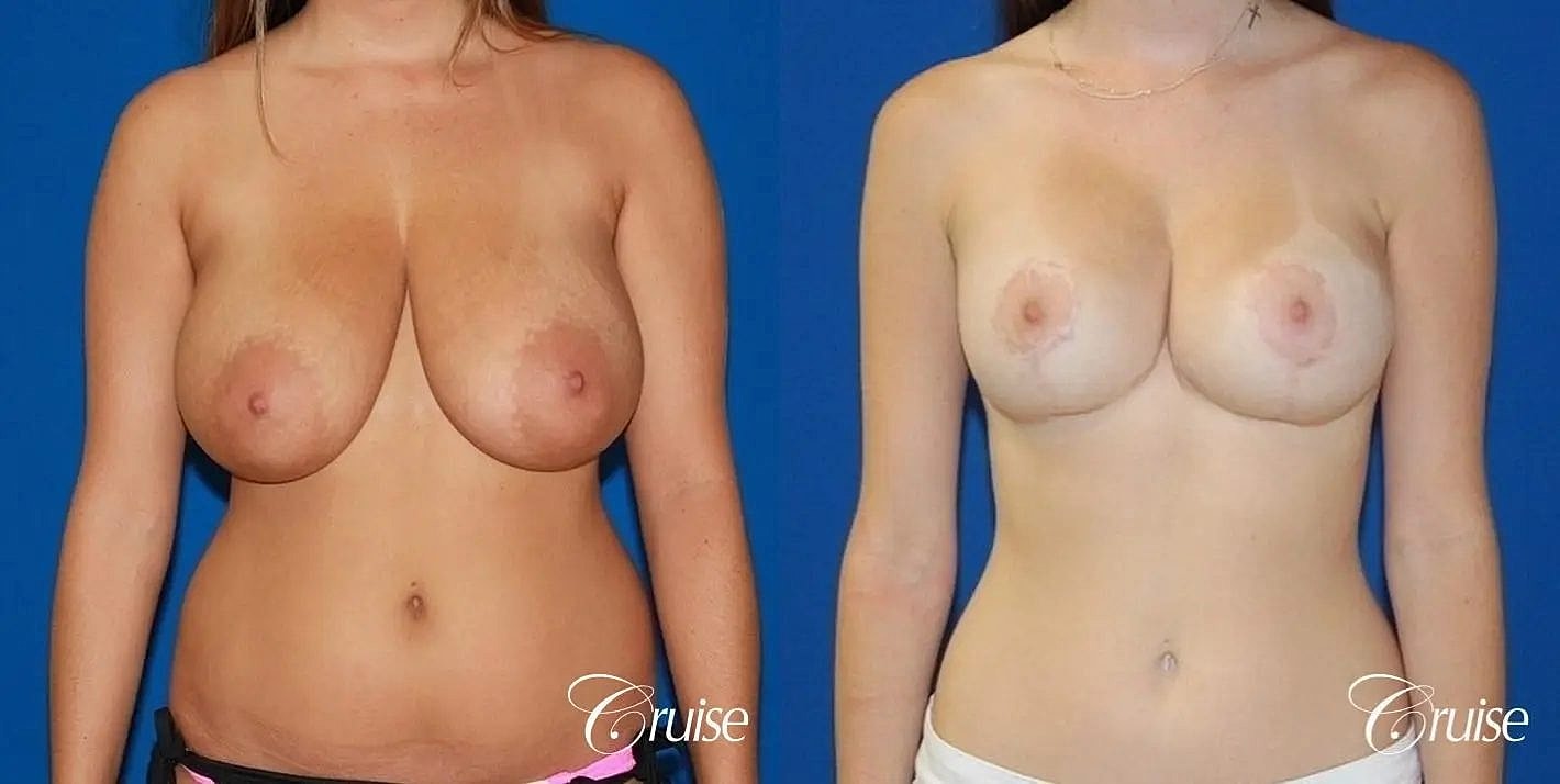 Breast Reduction Before & After