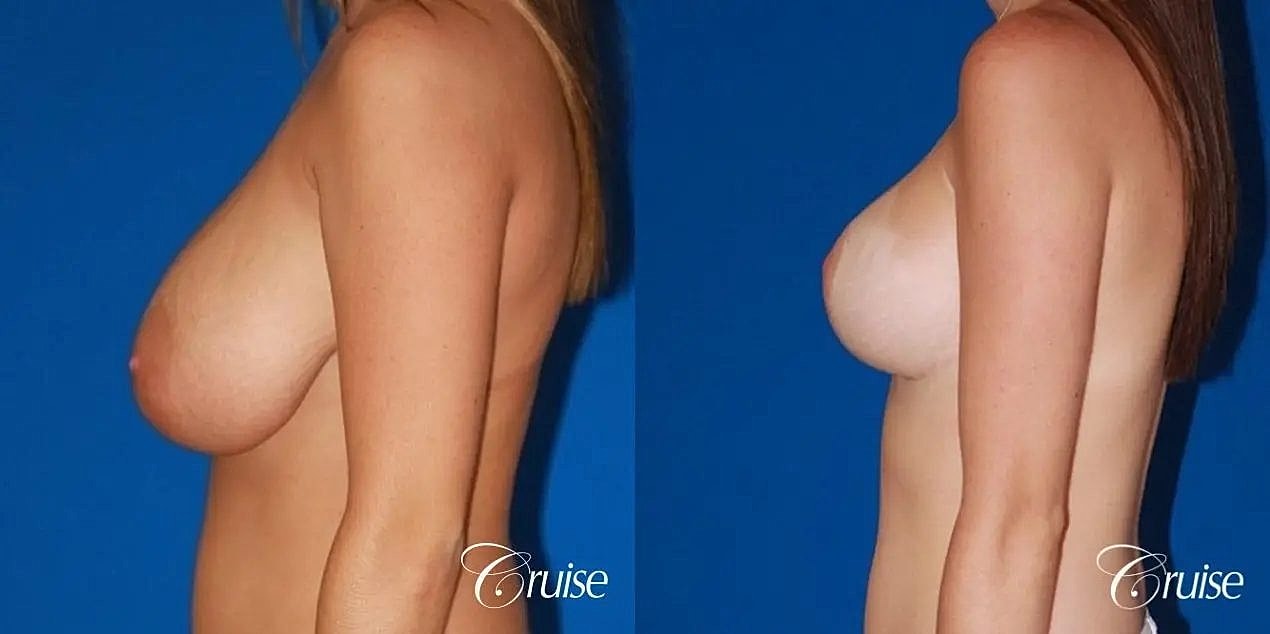 Breast Reduction Before & After
