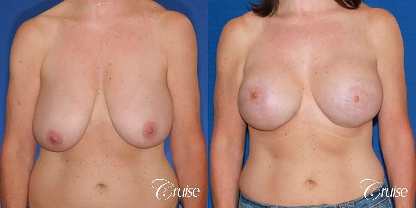 Breast Reduction Before & After