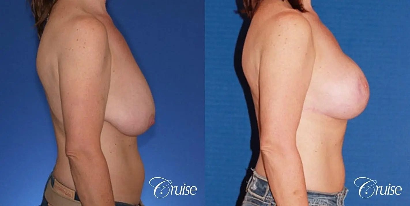 Breast Reduction Before & After