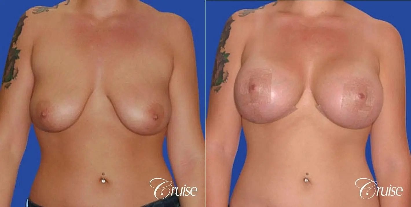 Breast Reduction Before & After