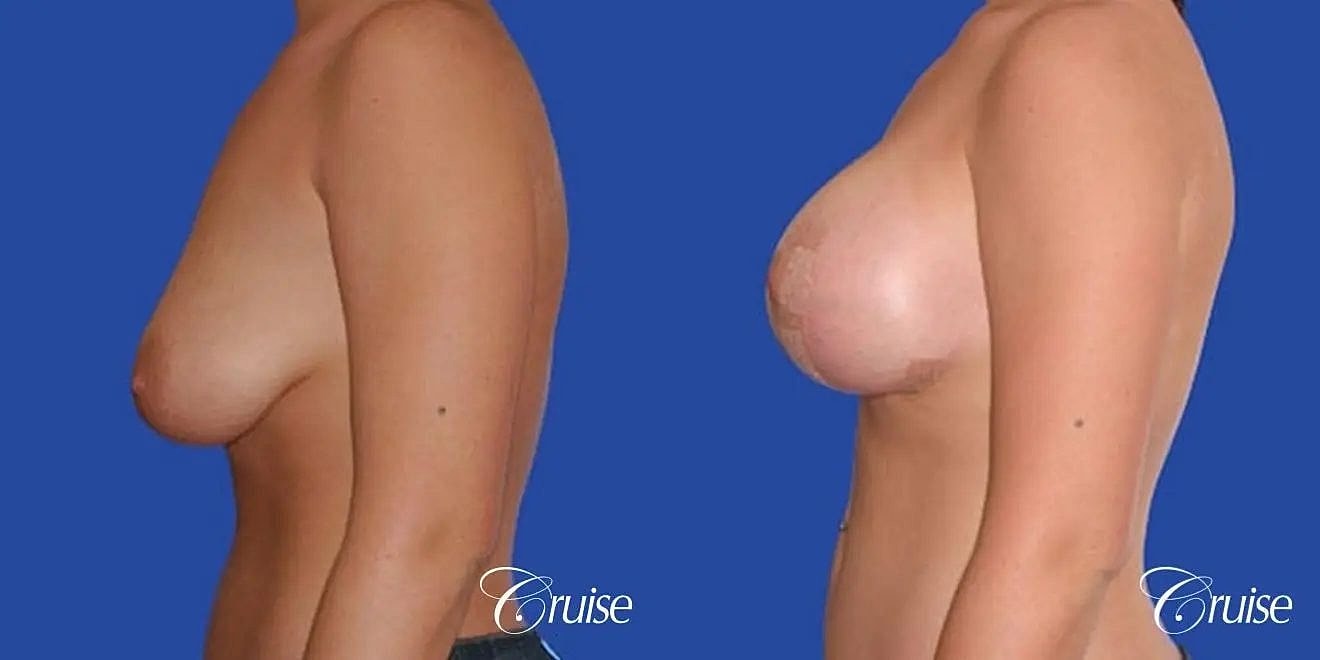 Breast Reduction Before & After