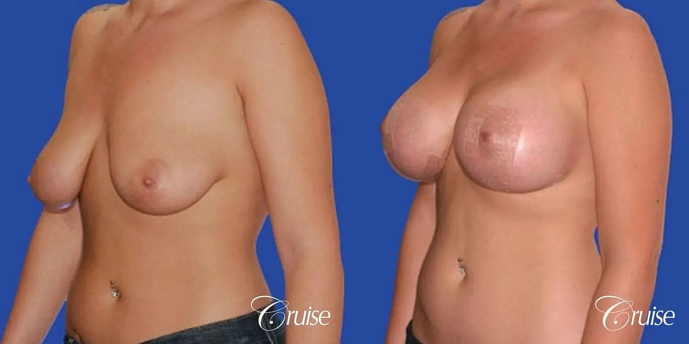 Breast Reduction Before & After