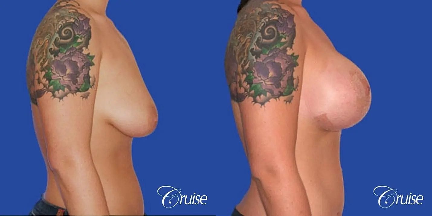 Breast Reduction Before & After