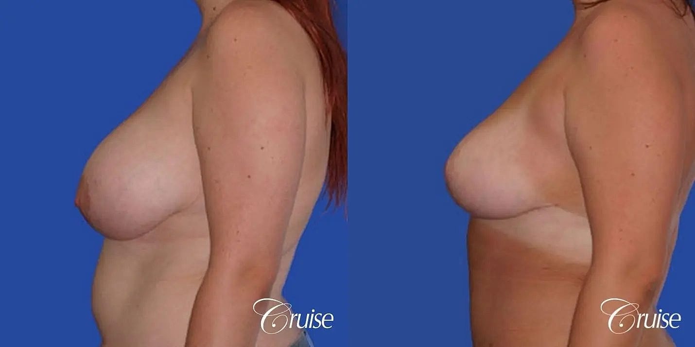 Breast Reduction Before & After