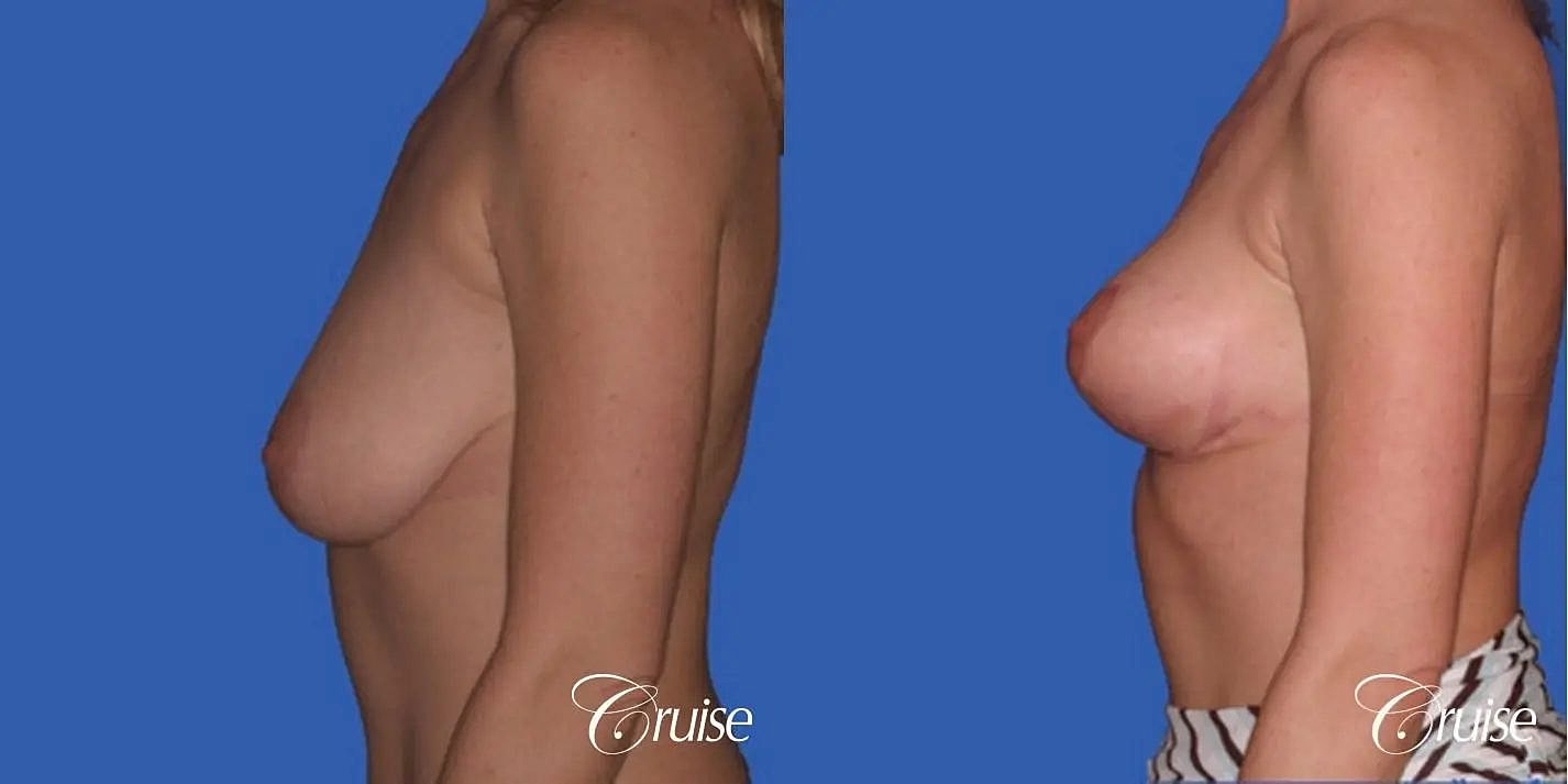Breast Reduction Before & After