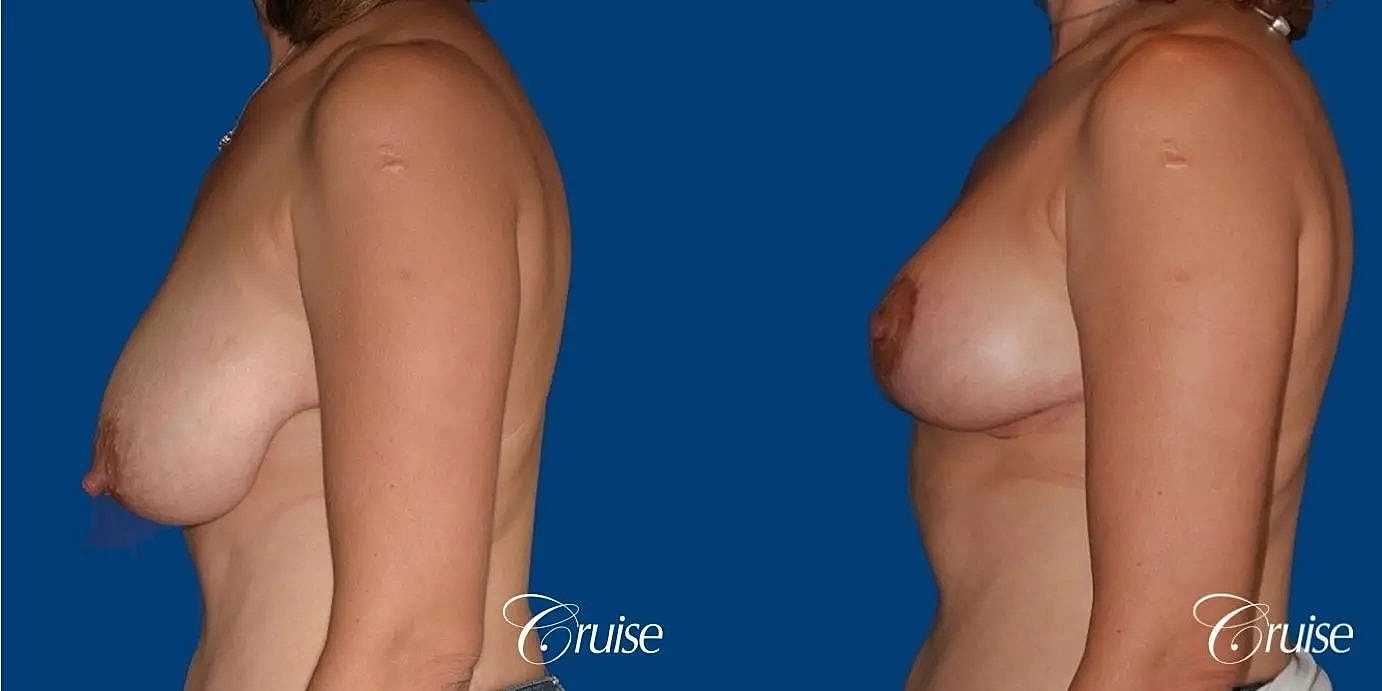 Breast Reduction Before & After