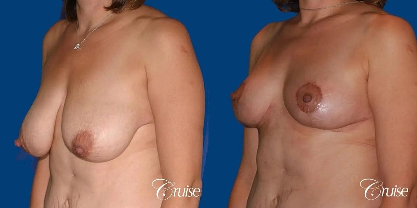 Breast Reduction Before & After