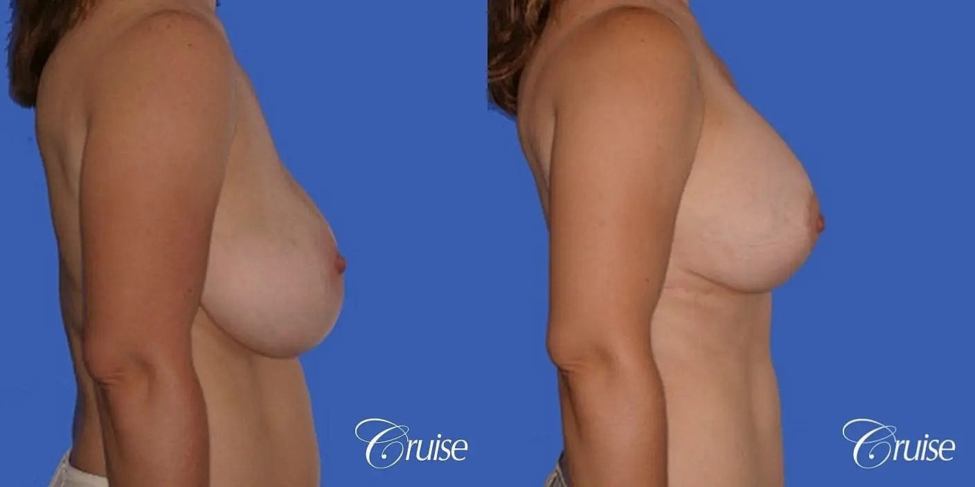 Breast Reduction Before & After