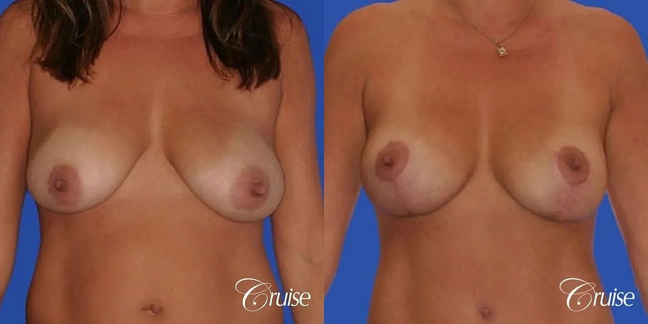 Breast Reduction Before & After