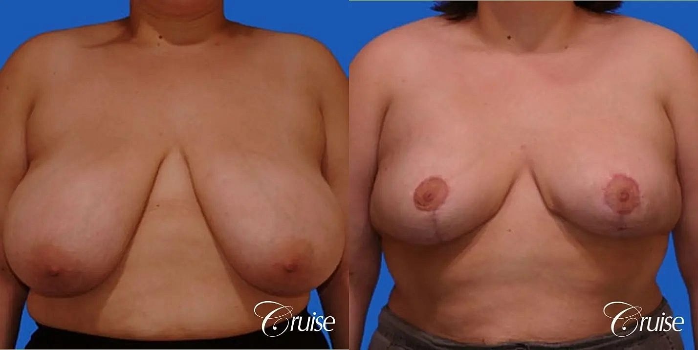 Breast Reduction Before & After