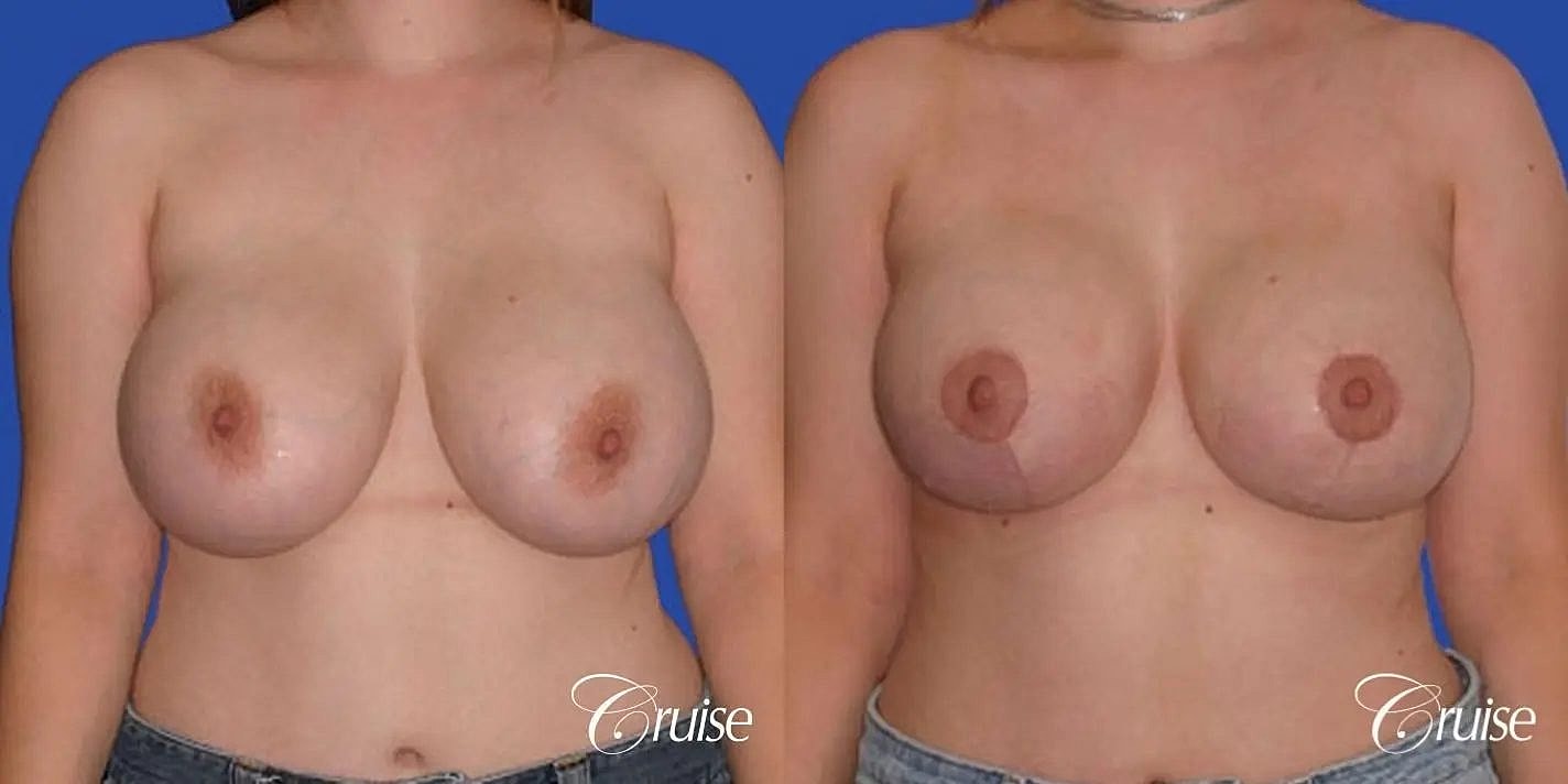 Breast Reduction Before & After