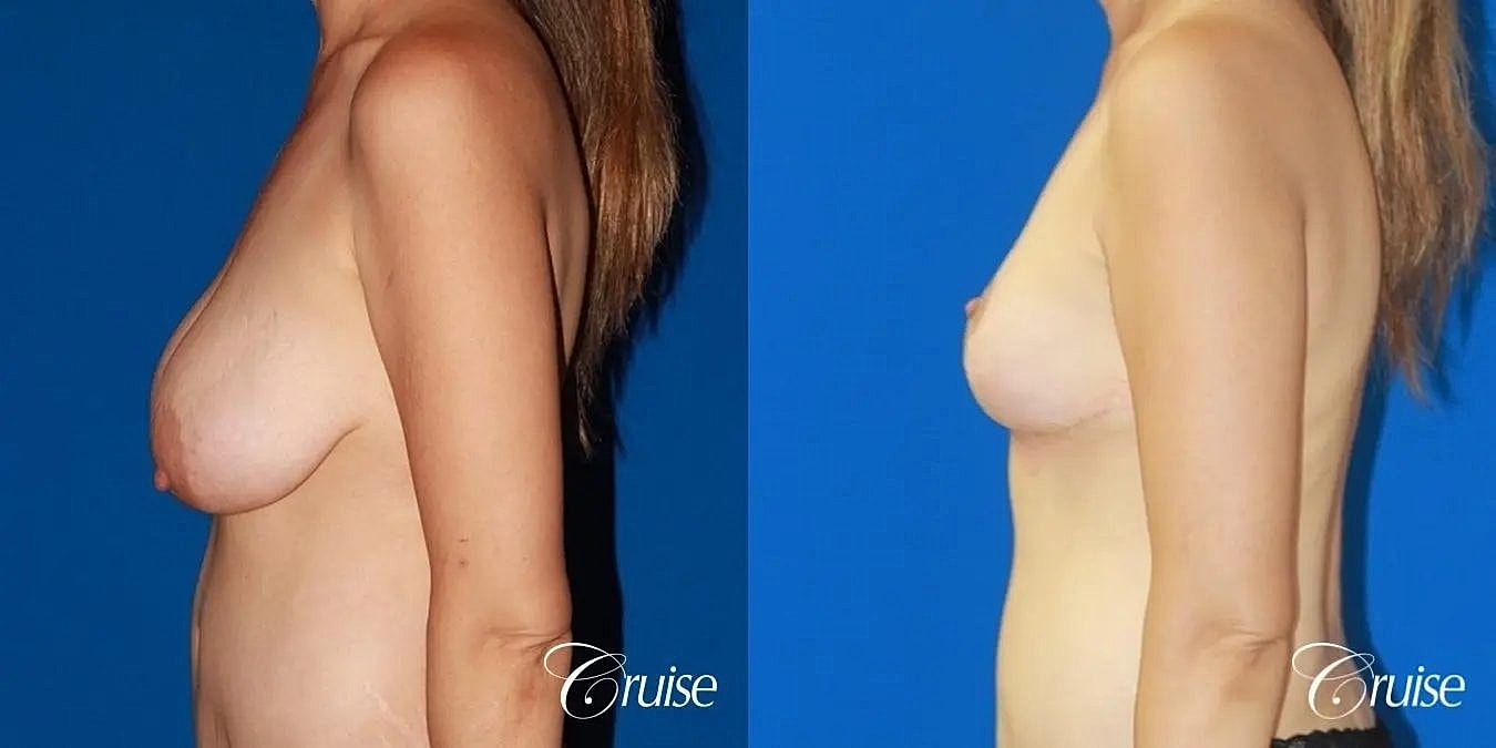 Breast Reduction Before & After