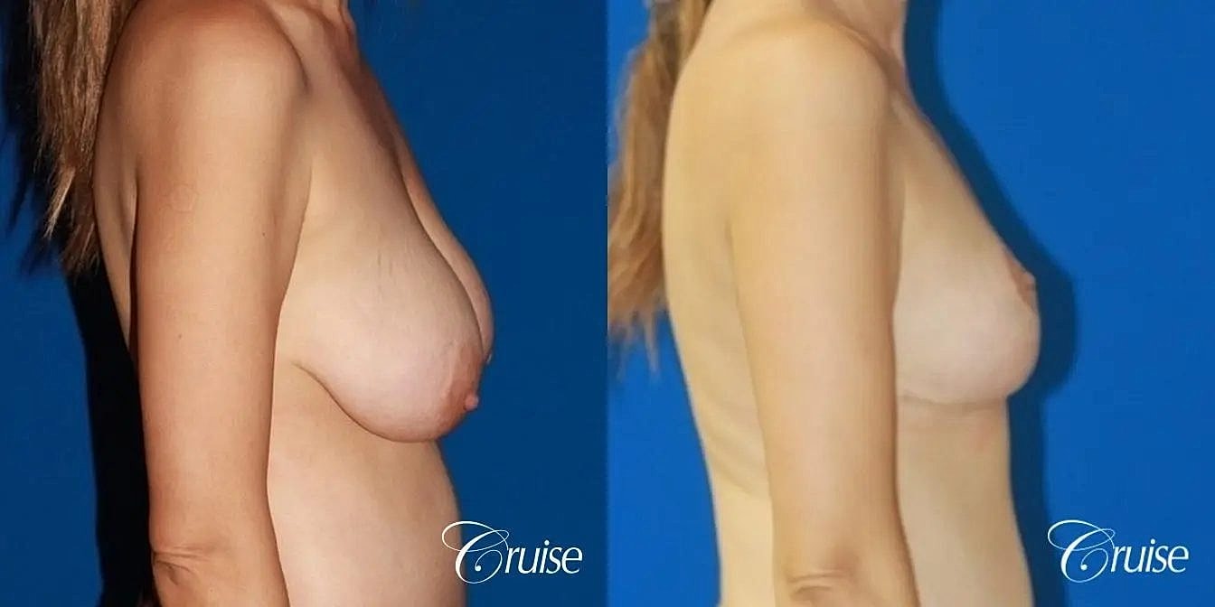 Breast Reduction Before & After