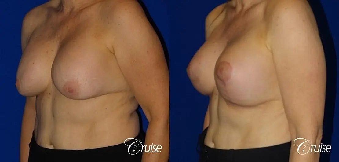 Breast Reduction Before & After