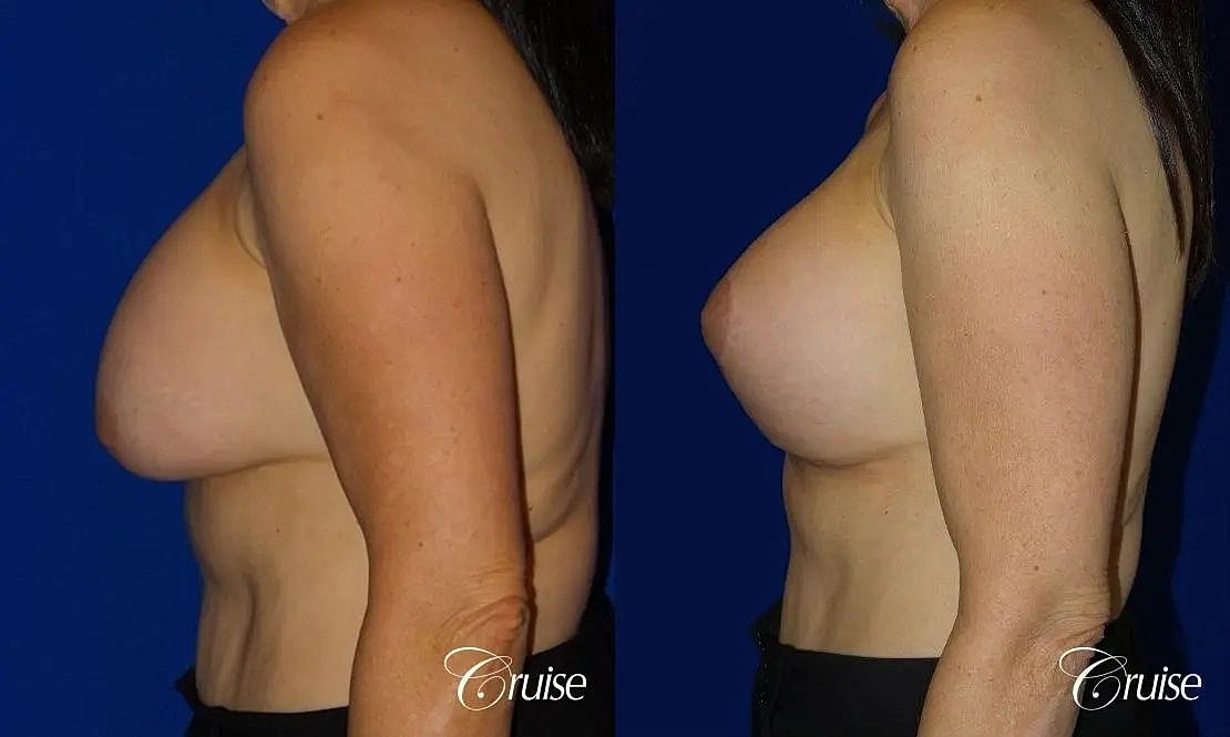 Breast Reduction Before & After