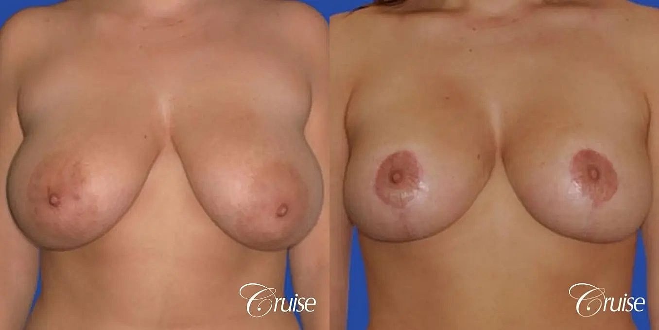 Breast Reduction Before & After