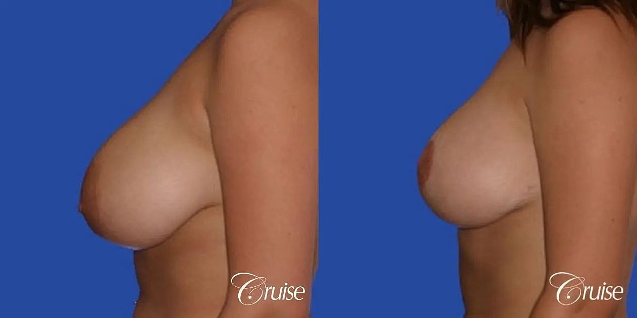 Breast Reduction Before & After