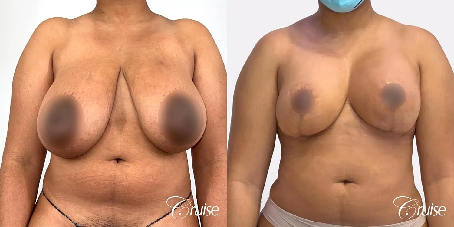 Breast Reduction Before & After