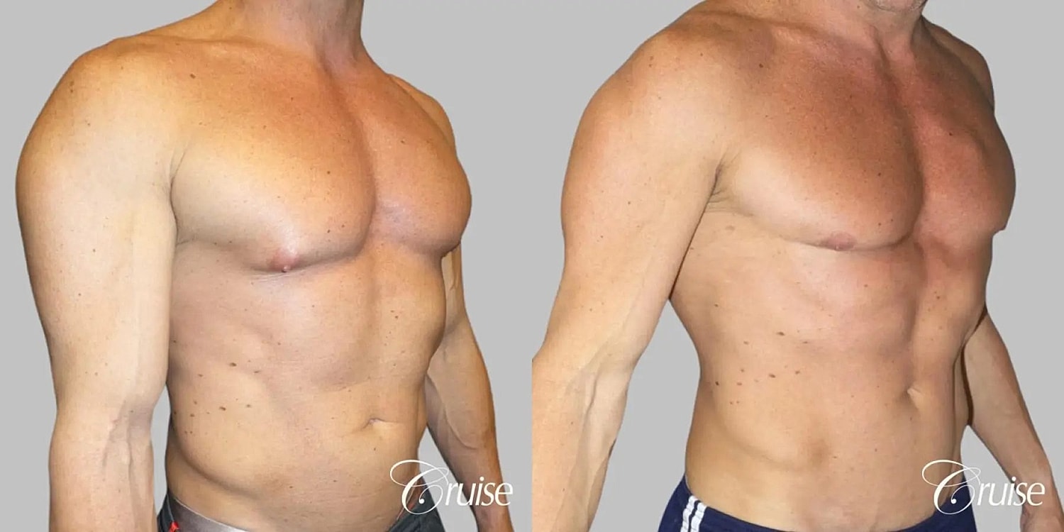 Gynecomastia Surgery Before & After