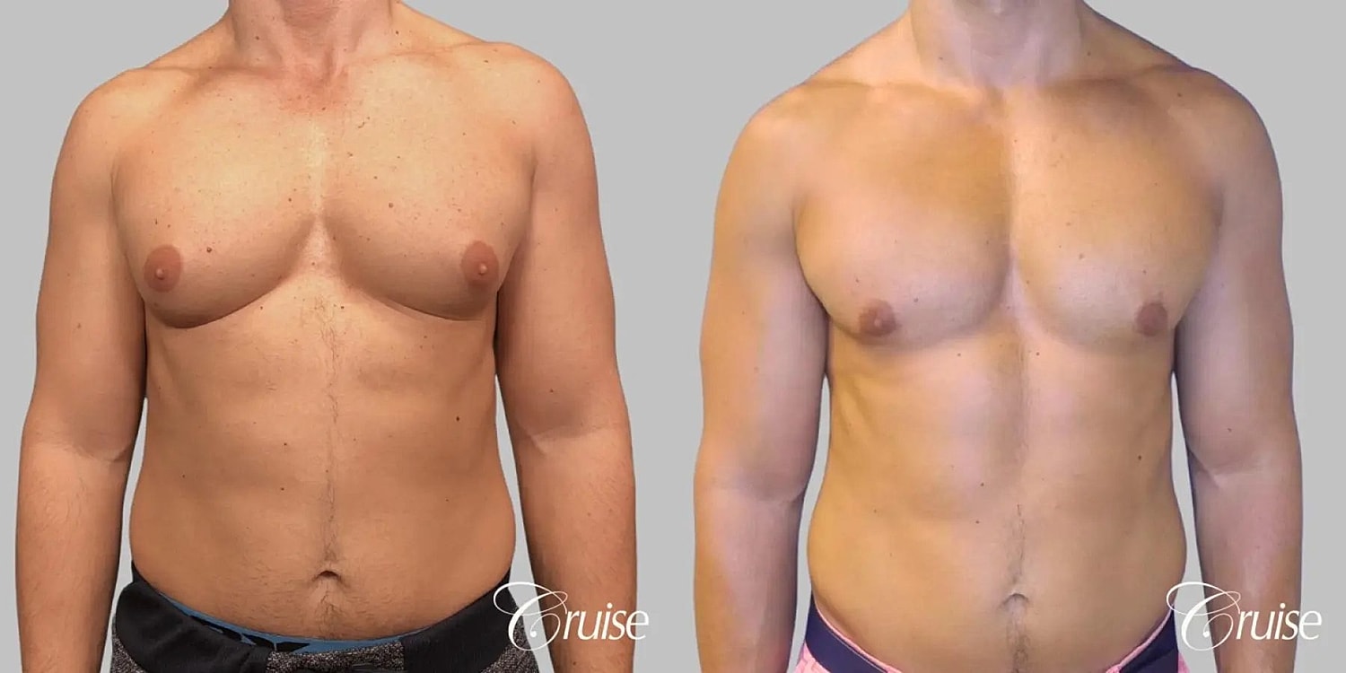 Gynecomastia Surgery Before & After