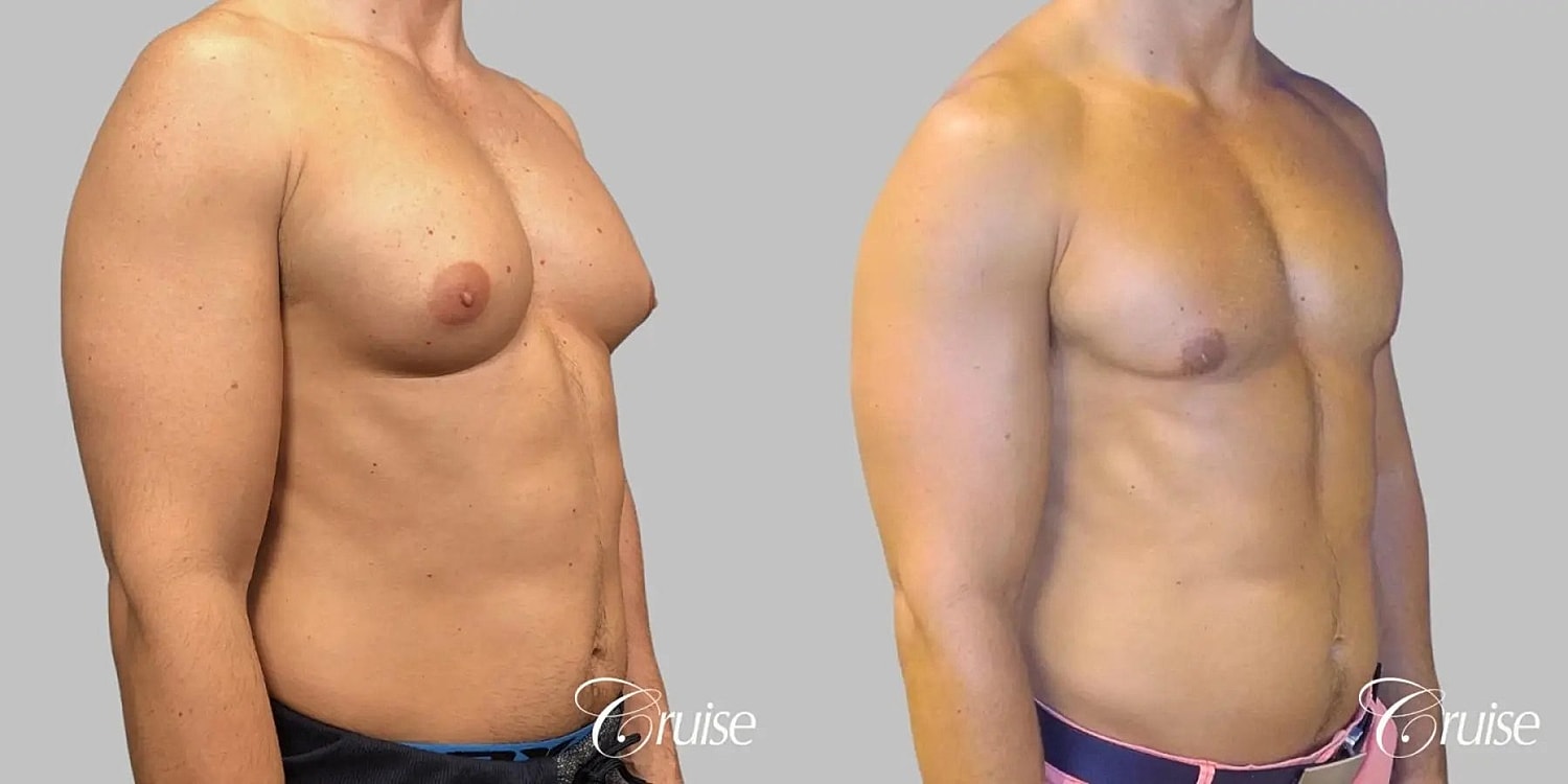 Gynecomastia Surgery Before & After