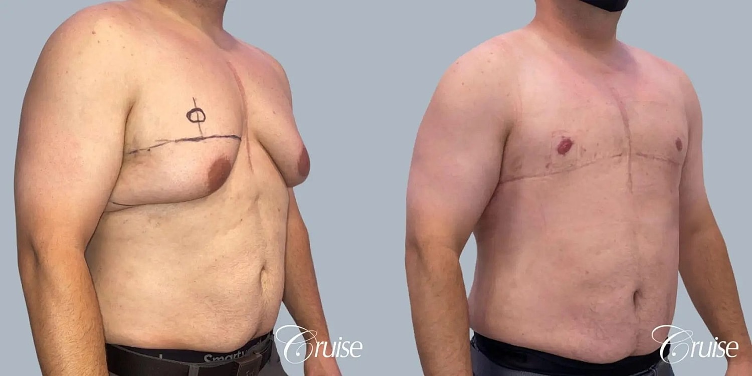 Gynecomastia Surgery Before & After