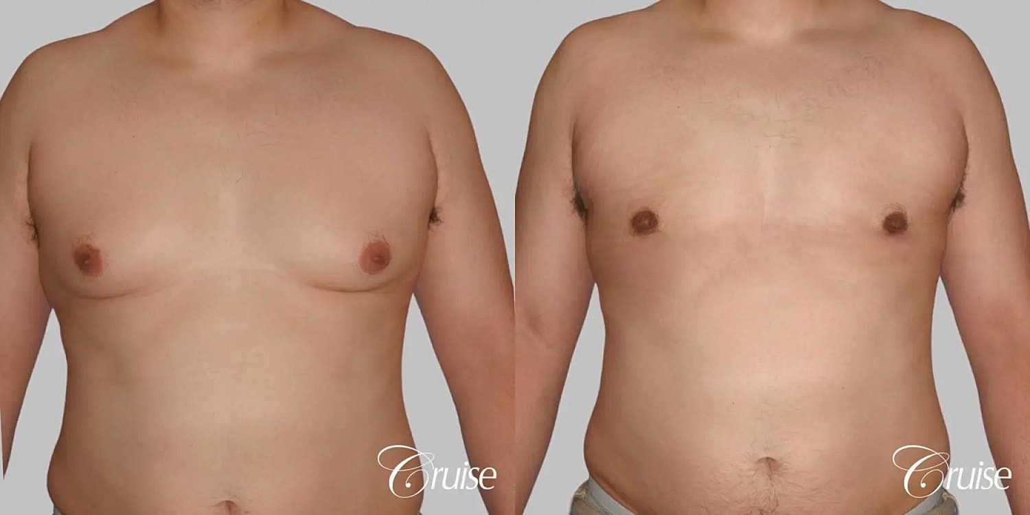 Gynecomastia Surgery Before & After